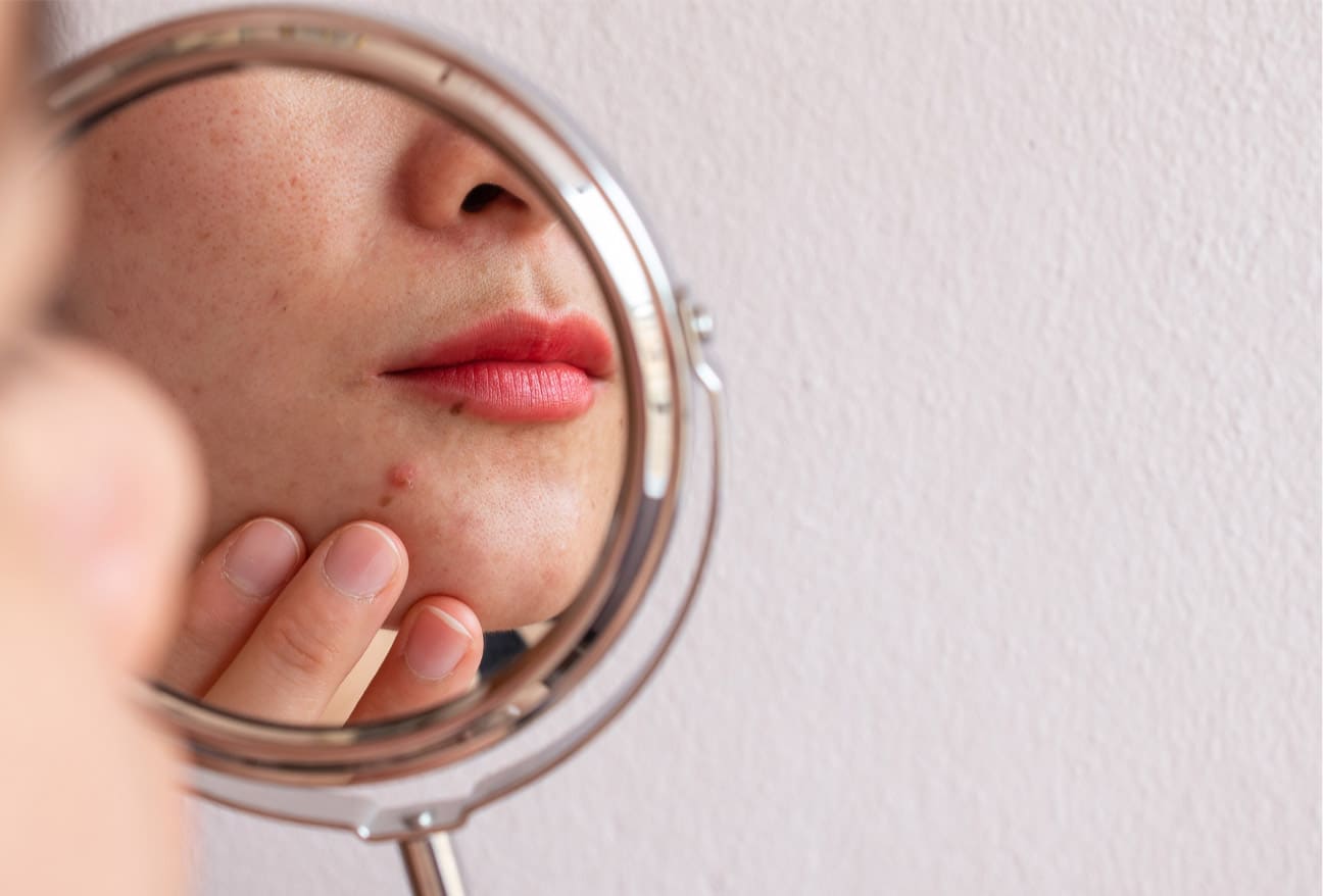 Difference between acne and pimple