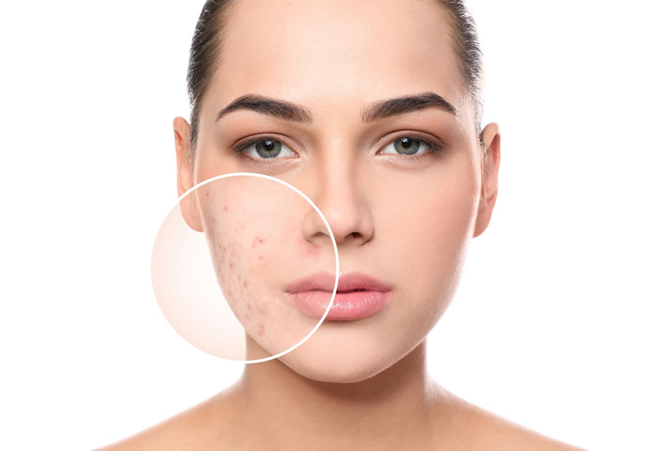How to Get Rid of Acne Scars Overnight