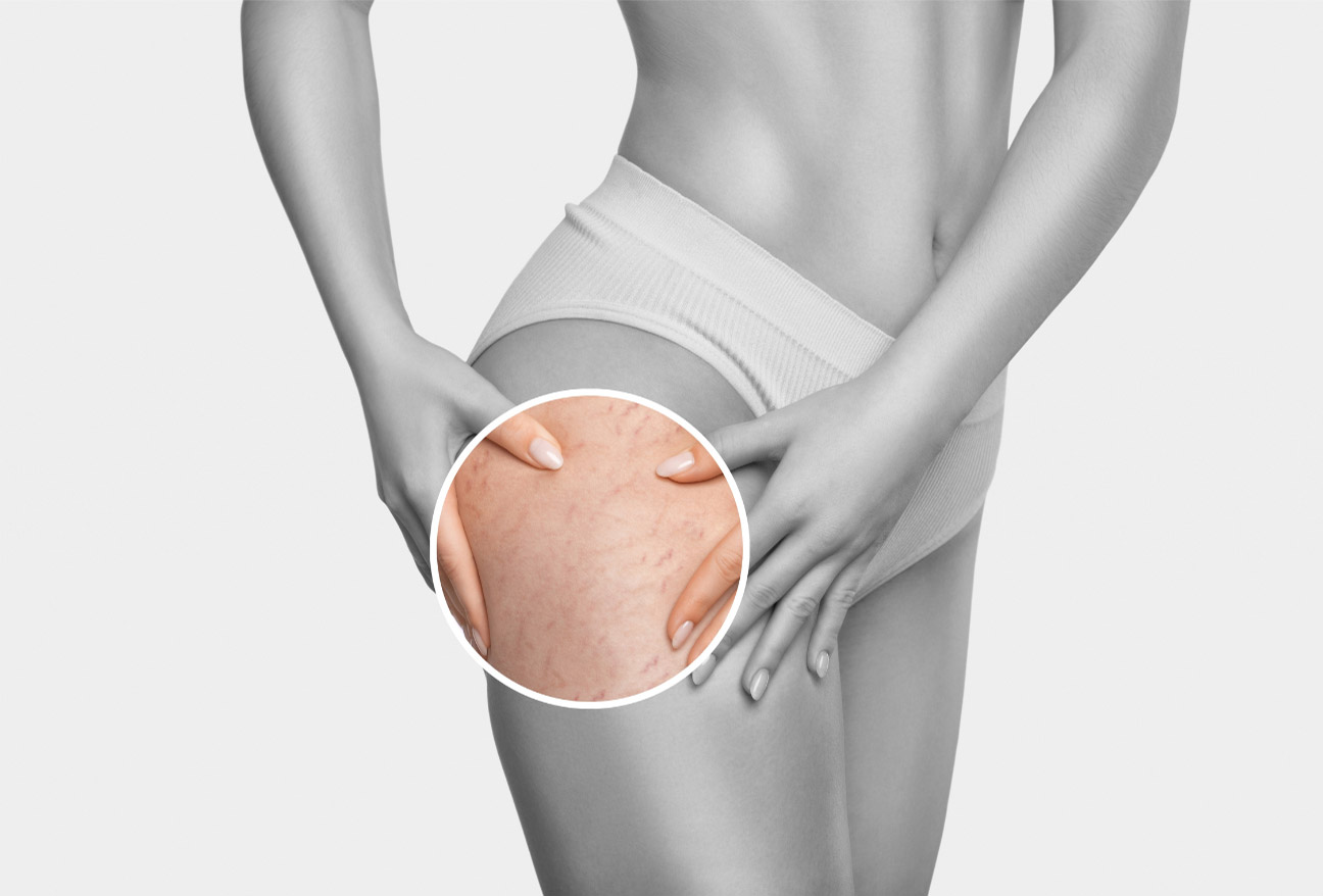 How to Remove Stretch Marks Permanently