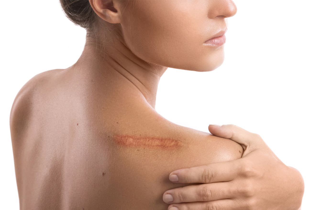 Keloid vs Hypertrophic Scar Comparison