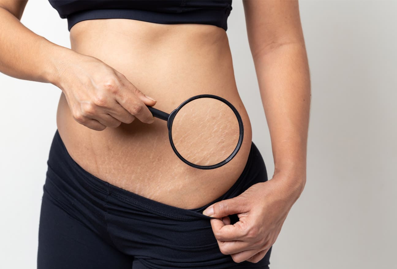 Showing different types of stretch marks and their characteristics