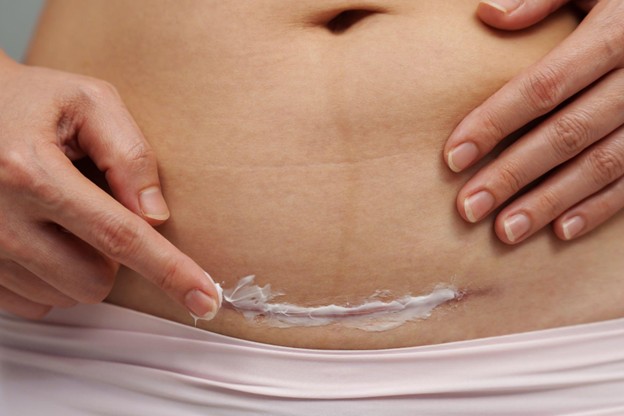 C-section Scars Types, Causes and Treatment Options