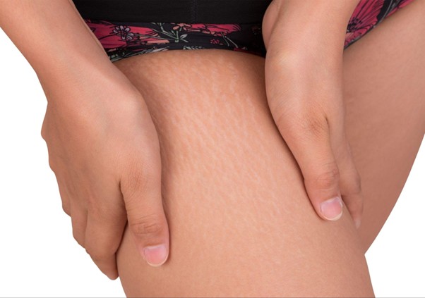 Red Stretch Marks on Thighs