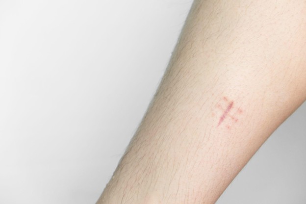 How to Remove Stitch Marks