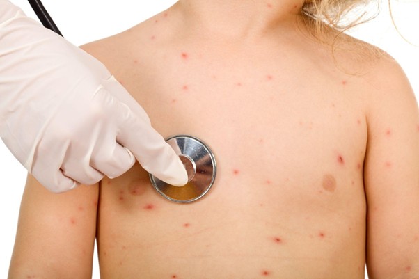 How to Fade Smallpox Scars