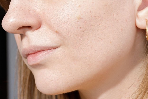 Atrophic Scar Treatment