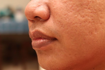 Ice Pick Scars Treatment, Causes and Prevention
